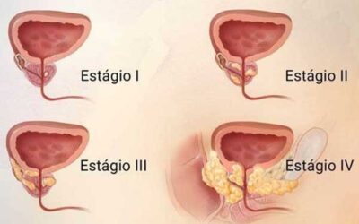 Câncer de próstata avançado tem cura?
